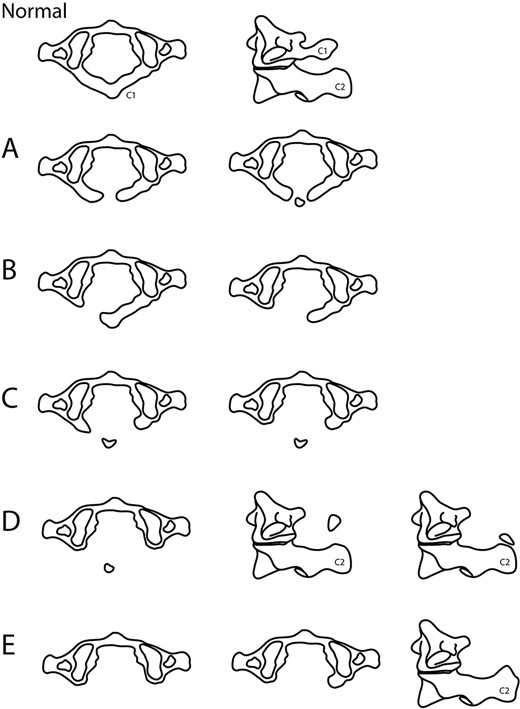 Currarino et al.’s classification of C1 hypoplasia. (A) Failure for midline fusion of both ossification centres of C1 posterior hemiarches; (B) Unilateral defect in one C1 posterior arch; (C) Bilateral clefts with preservation of most dorsal aspect; (D) Absence of C1 posterior arch (usually asymmetrical defects) with an unattached posterior tubercle of C1, which position may be well above or in contact with C2 spinous process; (E) Complete absence of C1 posterior arch and tubercle, spinous process of C2 may also be hypertrophied.