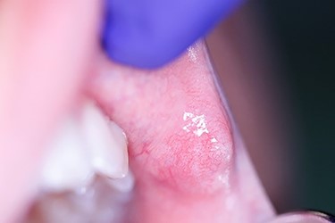 Lesion of the upper left lip.