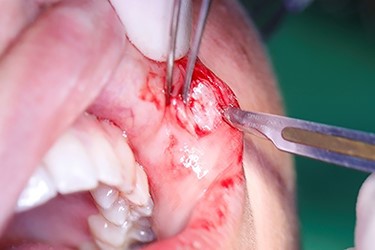 Excisional biopsy of the lesion.