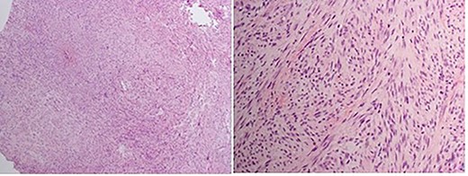 Haematoxylin and eosin stained section. Spindle cells arranged haphazardly and focally in poorly defined intersecting fascicles. Loose myxoid stroma with many vascular spaces in some parts. No cytological atypia or abnormal mitotic activity.