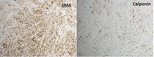 Immunohistochemistry for myofibroblasts. SMA and calponin stains the spindle cells.