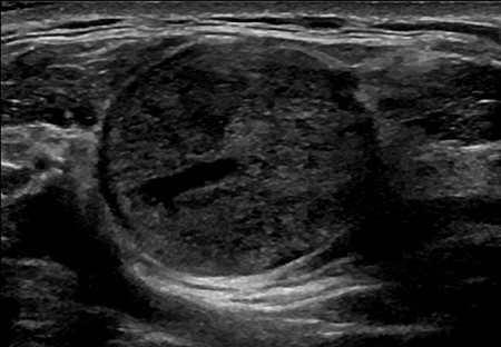 An ultrasound image of the well-circumscribed 22 × 22 × 25 mm round solid mass, which is located within the right supraclavicular fossa and intimately associated with the sternocleidomastoid muscle at its origin. The lesion demonstrates marked internal vascularity and is superficial to the carotid and visceral space.