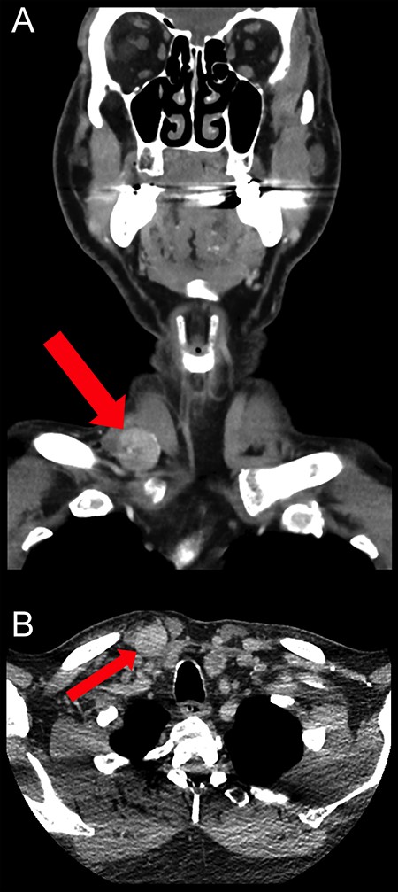 Coronal (A) and axial (B) CT scan images showing the well-circumscribed hypervascular mass measuring 22 × 19 mm within the right supraclavicular fossa at the origin of sternocleidomastoid muscle. It lies outside the carotid and visceral space with no underlying erosion of the clavicle.