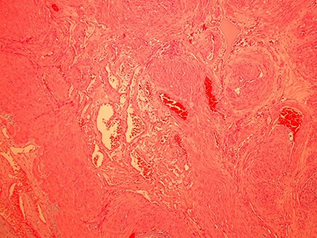 A representative haematoxylin and eosin (H&E) histological image (100× magnification) of the right supraclavicular venous subtype angioleiomyoma showing variably sized blood vessels with thick walls and prominent muscle.