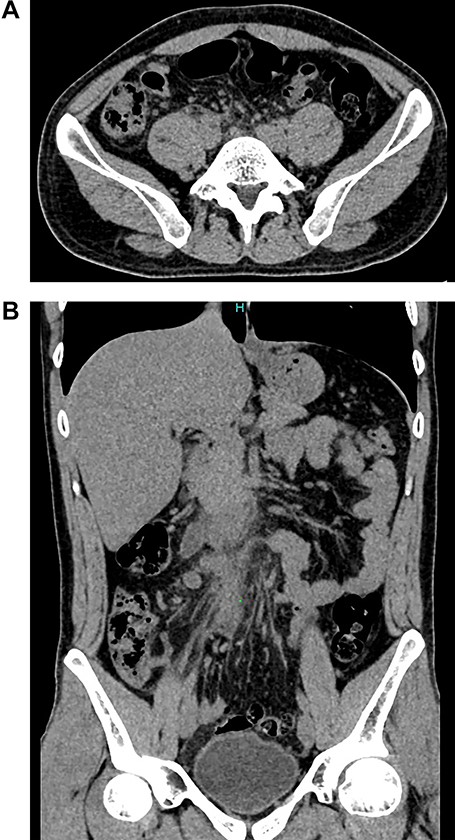 (A) CT, slight enhancement of the retroperitoneal fat. (B) CT, the appendix is seen with surrounded by retroperitoneum fat.