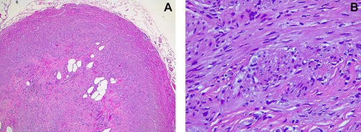 (A) Pathology, appendiceal lumen with complete obstruction due to proliferation of neural fusiform cells. (B) Pathology, neural fusiform cells without atypia.