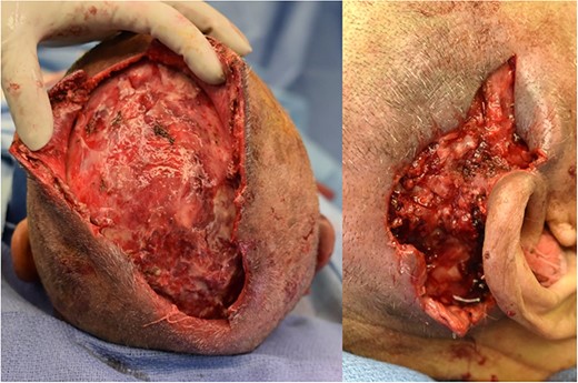 Wound bed of scalp (left) and posterior auricular (right) wounds after multiple debridments. The scalp wound ultimately measured 20 cm in length, 10 cm in width and 2 cm depth. The right posterior auricular wound measured 7 × 7 × 2 cm. Wound bed free of purulent drainage and WBC down trending with sepsis resolving.