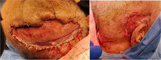 Split-thickness skin graft placement on scalp (left) and right posterior auricular region (right). Split-thickness skin graft placed after multiple bedside and mechanical debridement carried out. Versajet used to clean the wound bed prior to placement of skin graft. Good granulation tissue present and spilt thickness skin graft taken from left thigh and meshed with 1:1.5 dermacarrier.