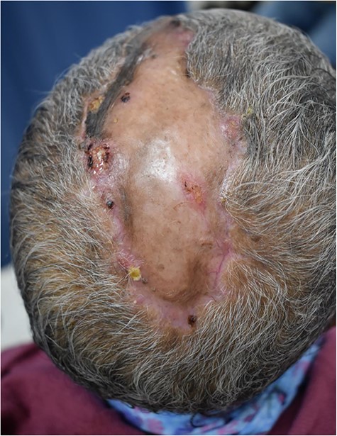 Postoperatively wound after discharge home. Skin graft healed well with some surrounding areas of hyperpigmentation. No areas of the graft were rejected.