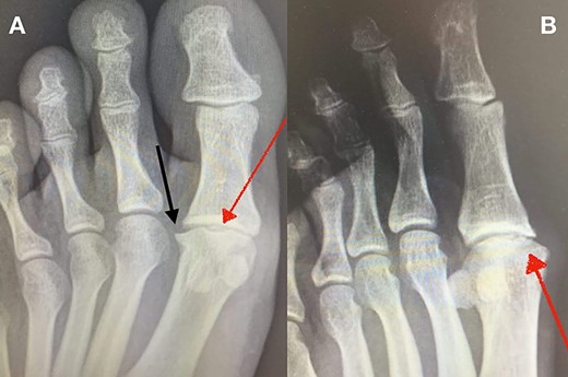 (A + B): (A) Anteroposterior, weight-bearing, X-ray view of the left foot. The red arrow shows a lytic lesion of the subchondral bone, indicating a possible OD lesion on the MH. The black arrow shows the formation of a small, lateral osteophyte. (B) Oblique X-ray view of the left foot. The red arrow shows again radiolucency of the cortical bone as well as small fragmentation of the MH.