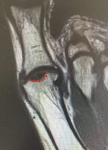 MRI of the left foot, shows low signal intensity lesion on the MH. The red dots show the depth of a subchondral cyst formation.