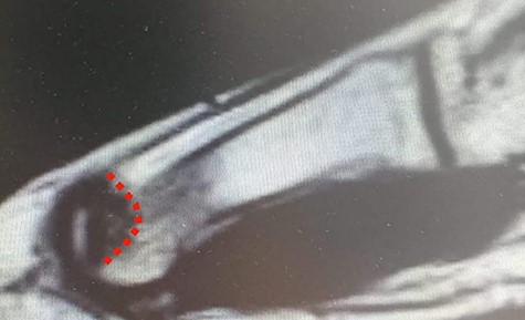 MRI (sagittal view) of the left foot. The red dots show a deep MH defect involving the subchondral bone, a typical finding of OD.