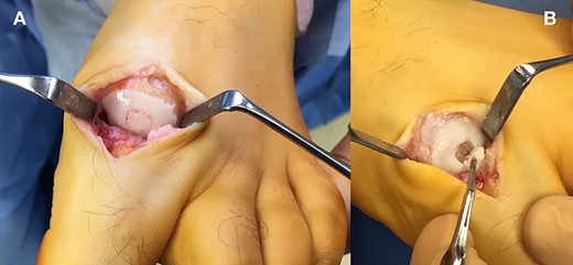 (A + B): (A) Intraoperative image, showing a central, partially detached, but not displaced from the surrounded bone OD lesion. (B) Under the OD fragment, an empty cavity with a defect and central depression into the subchondral bone was obvious.