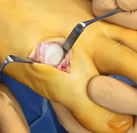 Intraoperative image after filling the empty cavity with autologous cancellous bone. The edges of the cartilaginous surface were sealed with fibrin glue.