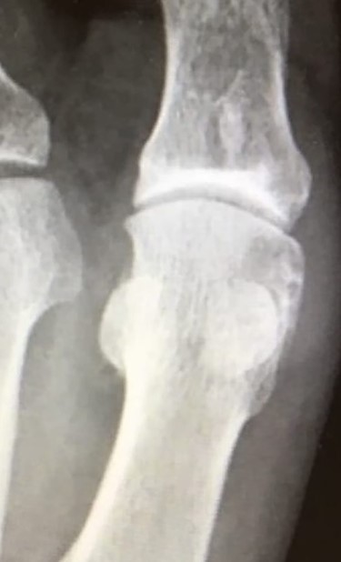 Anteroposterior X-ray view of the left foot at 12 months follow-up showing a good-restoring articular cartilage and joint regularity.