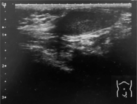Ultrasonography (6 months of age). The left testis is located within the inguinal canal.