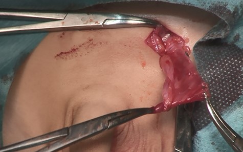 Intraoperative photography (14 months of age). After opening the inguinal canal, only a patent processus vaginalis is visible.