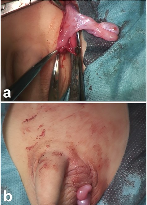 Intraoperative photography (14 months of age). (a) The testis is retrieved from the abdominal cavity. (b) After the patent processus vaginalis is closed, the testis is guided into a dartos pouch and fixed to the pouch wall.