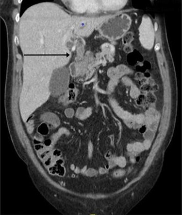 Computed tomography imaging showing continuous tubular structure extending from the left hepatic lobe to the stomach.