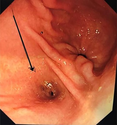 Oesophagogastroduodenoscopy (OGD): pre-pyloric fistula—ectopic opening of the ACBD.