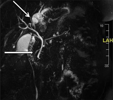 MRCP: open arrow—the left IHDs drain via an aberrant (left) extra-hepatic bile duct into the pyloric region without communication with the (right) intra- and extra-hepatic bile ducts. Closed arrow—pancreatic divisum and side branch IPMN.