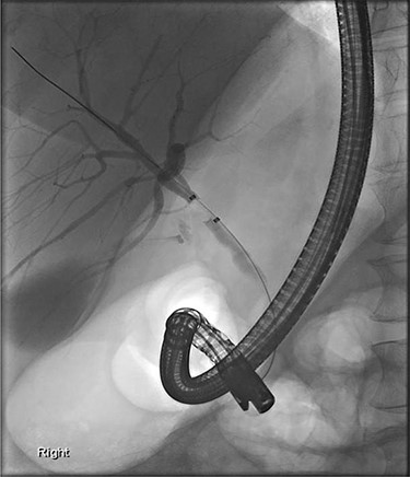 ERCP: cannulation via the major papilla orifice into the CBD draining the right IHDs. There was no communication between the ACBD and the right IHDs.