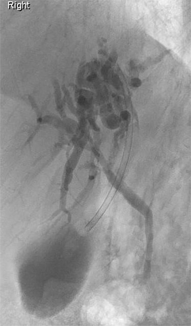 ERCP: cannulation via the pre-pyloric fistula opening. Contrast outlining the ACBD and the left IHDs.