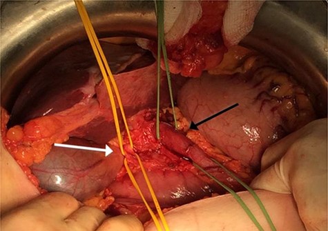 Intraoperative image showing a dilated ACBD draining segments 2–4 (black arrow) and the right sided non-dilated CBD (white arrow).