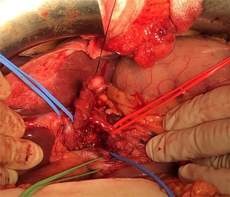 Intraoperative image. Blue sling: portal vein. Green sling: right extra-hepatic bile duct. Black sling: ACBD.