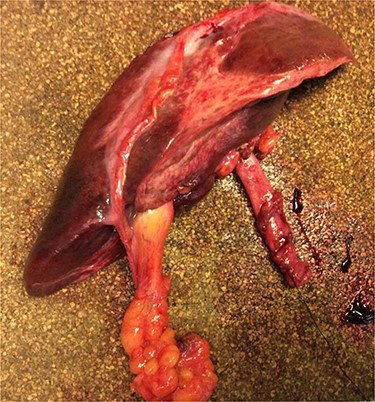 Specimen: left hemi-hepatectomy and the resected ACBD.