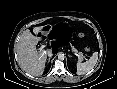 Intestinal loops (arrow) between the inferior vena cava and portal vein.