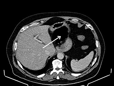 Intestinal loops (arrow) displacing the stomach to the left.