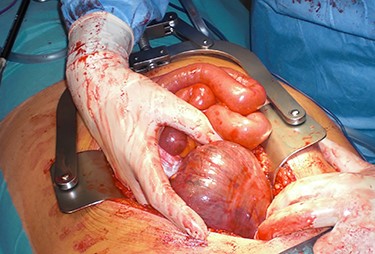Herniated caecum and ascending colon through the foramen of Winslow.