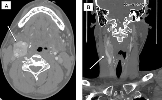 (A) CTA sagittal view, white arrow pointing to the CBTs encasing the ICA and ECA corresponding to Shamblin III. (B) CTA coronal view, white arrow pointing at the CBTs.