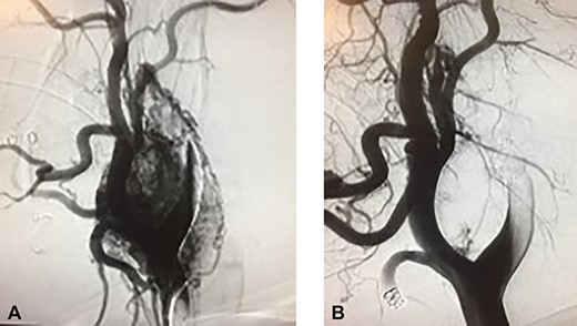 (A) Preembolization angiogram. (B) Postembolization angiogram.