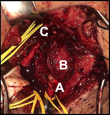 (A) Tumor at the bifurcation. Transected common carotid artery. (B) CBTs. (C) Internal carotid artery.
