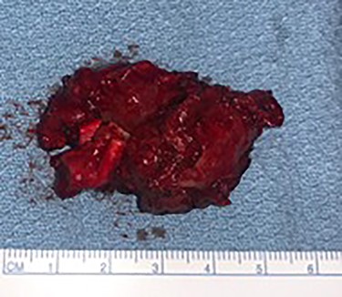 CBTs specimen, posterior view with the bifurcation attached to it.