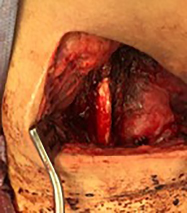 ICA to CCA reconstruction with PTFE.