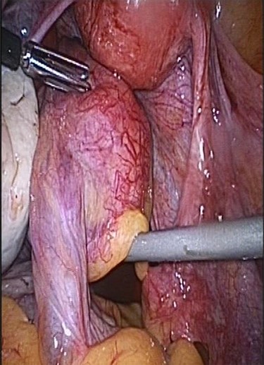 Torsion of intestinal parasitic myoma inside the peritoneal cavity.