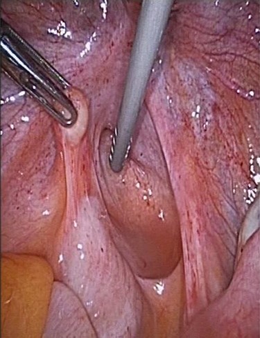 Parasitic myoma infiltrated inside the peritoneal cavity.