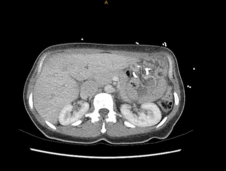 Computer tomography findings of alimentary limb jejunal intussusception into the gastric pouch, through the MiniMizer gastric ring.