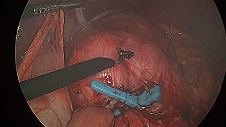 This figure demonstrates operative findings prior to surgical manipulation. The MiniMizer band is present at forefront, 3 cm distal to gastrojejunal anastomosis. The intussusception and internal herniation may be difficult to appreciate from this image.