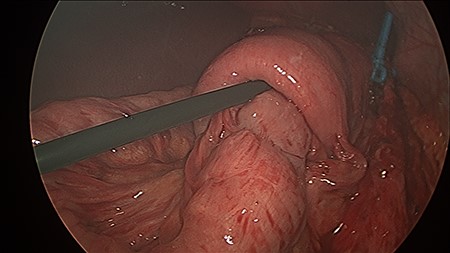 The MiniMizer ring has been removed. Alimentary limb jejunal intussusception and left to right remnant stomach herniation can be appreciated. Gentle traction on the intussusceptum resulted in 25 cm of viable bowel pulled from the invagination.