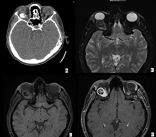 (A–D) Imaging features of MCS: CT scans demonstrated an ovoidal soft tissue mass with central calcification (A), T2 (B) and T1 (C) weighted images showing an oval tumor with iso-hyperintense signal with a calcified central component. Enhanced T1 weighted image demonstrating an omogenous tumoral enhancement except for the central calcified part (D).
