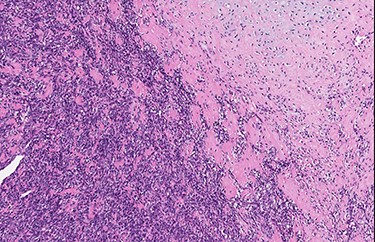 Abrupt transition from small cell component to well differentiated cartilaginous area (H&E, high power view).