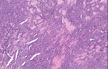 Typical hemangiopericytoma-like vascular pattern (H&E, high power view).