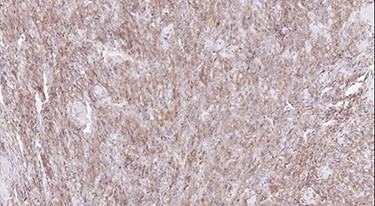 Immunohistochemical features of MCS: cytoplasmic positivity for CD99 in the small cell component (IHC stain).