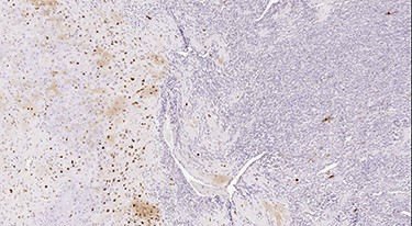Nuclear positivity for S100 in the cartilaginous component (IHC stain).