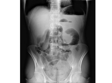 Abdomen X-ray revealing enteric air-fluid levels.