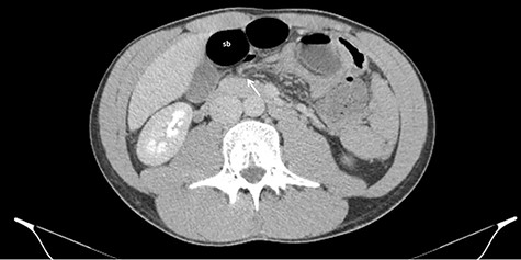 Axial CT images of dilated small bowel (sb) with the respective mesentery converging to the hernia defect (white arrow) in the gastrohepatic ligament.